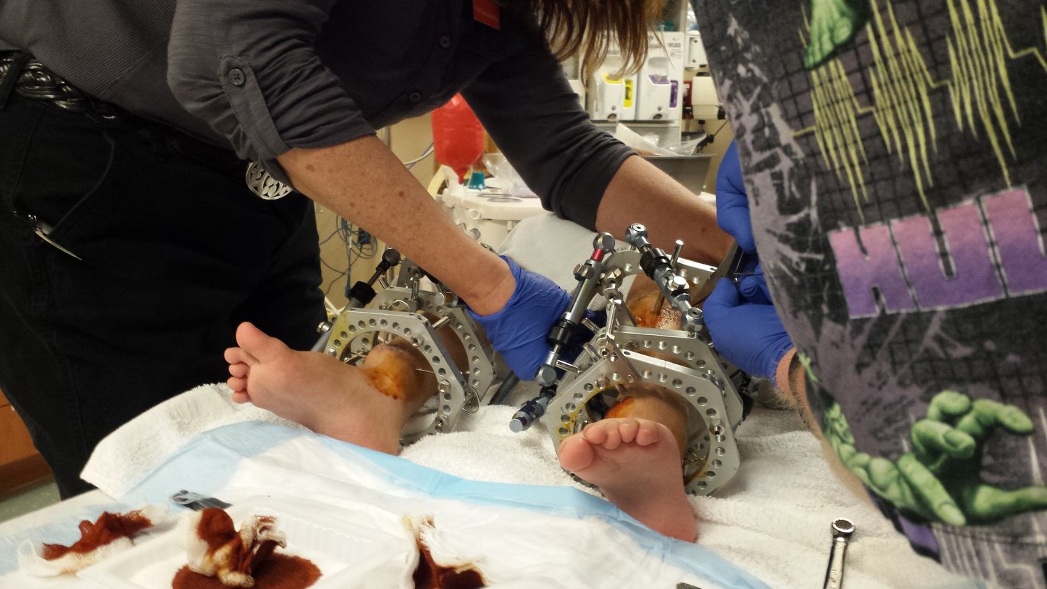 Fixators coming off! A I Dupont Hospital for Children, Delaware