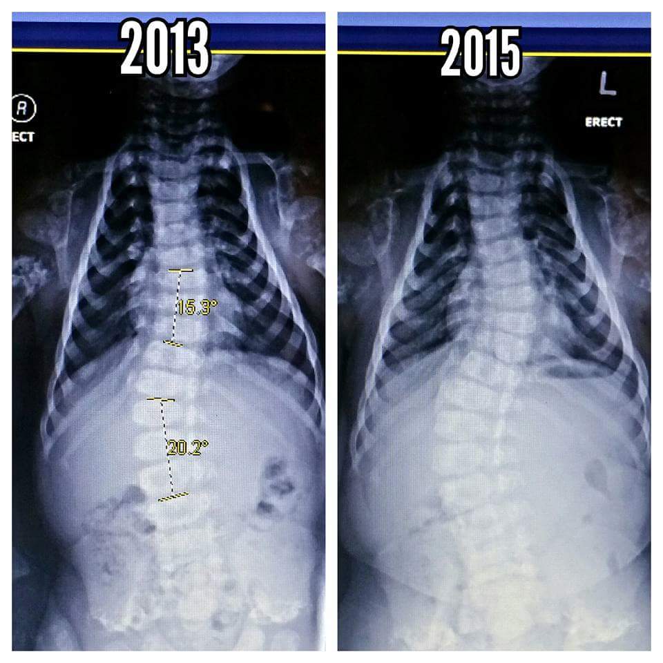 Levi's bending spine, Ocean Springs Hospital