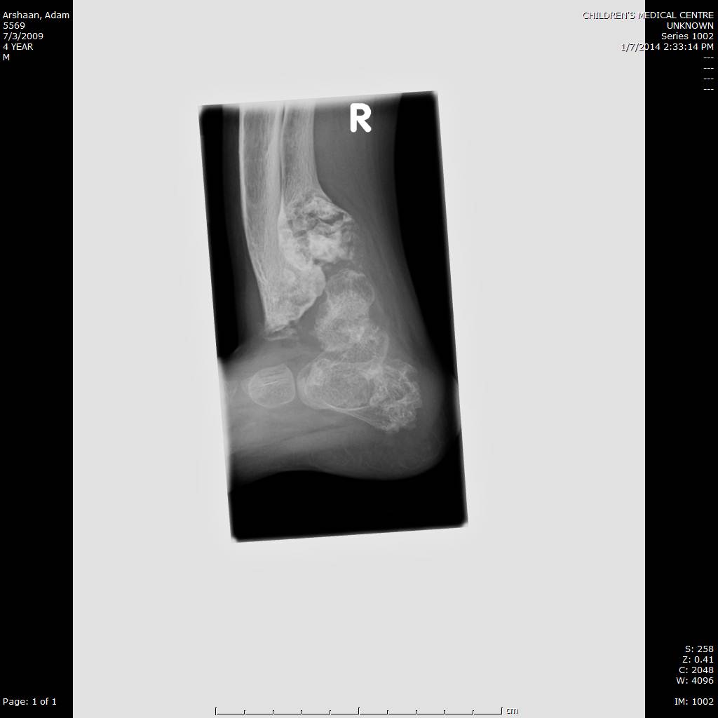 Clinical photo of patient with Jansen's disease
