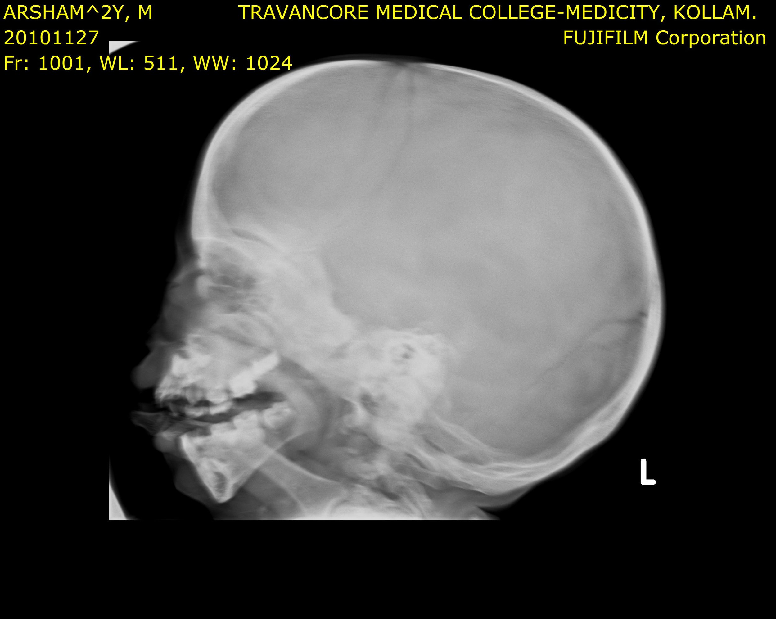 Skull X-ray showing features of Jansen's disease