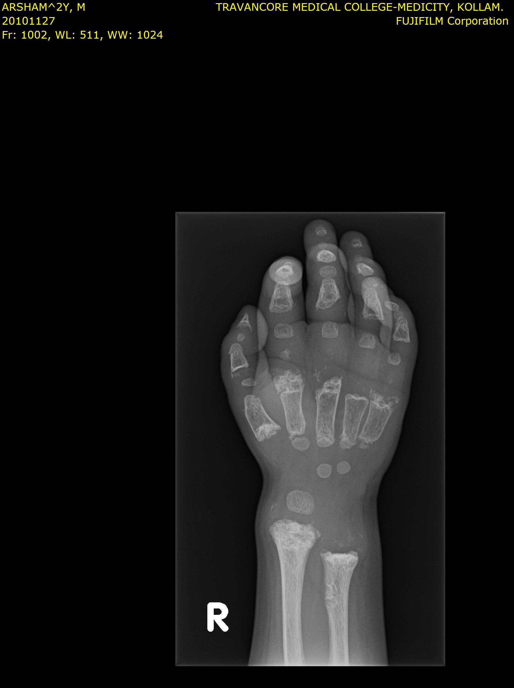 Hand X-ray showing clinodactyly