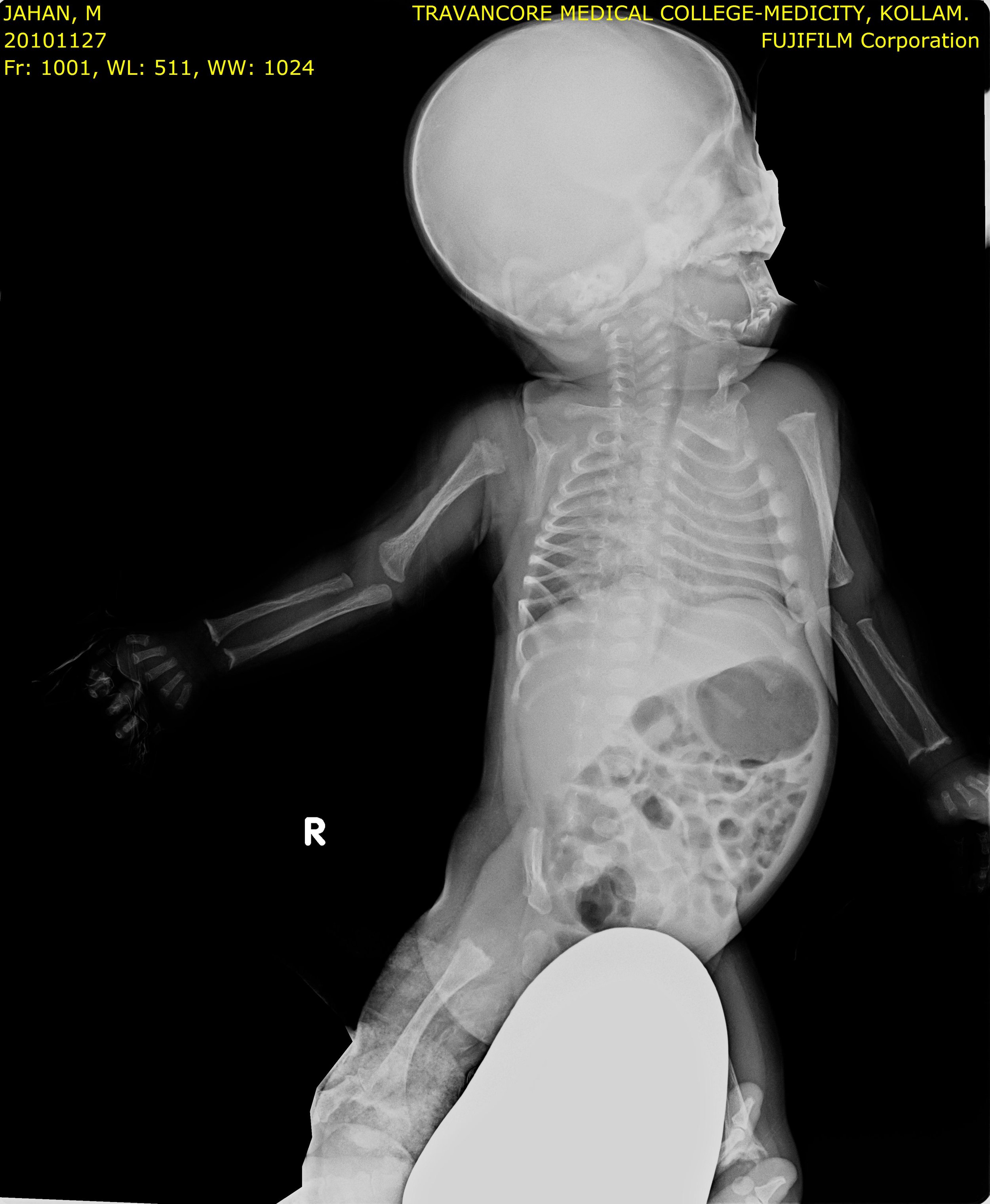 Radiographic image associated with Jansen's disease